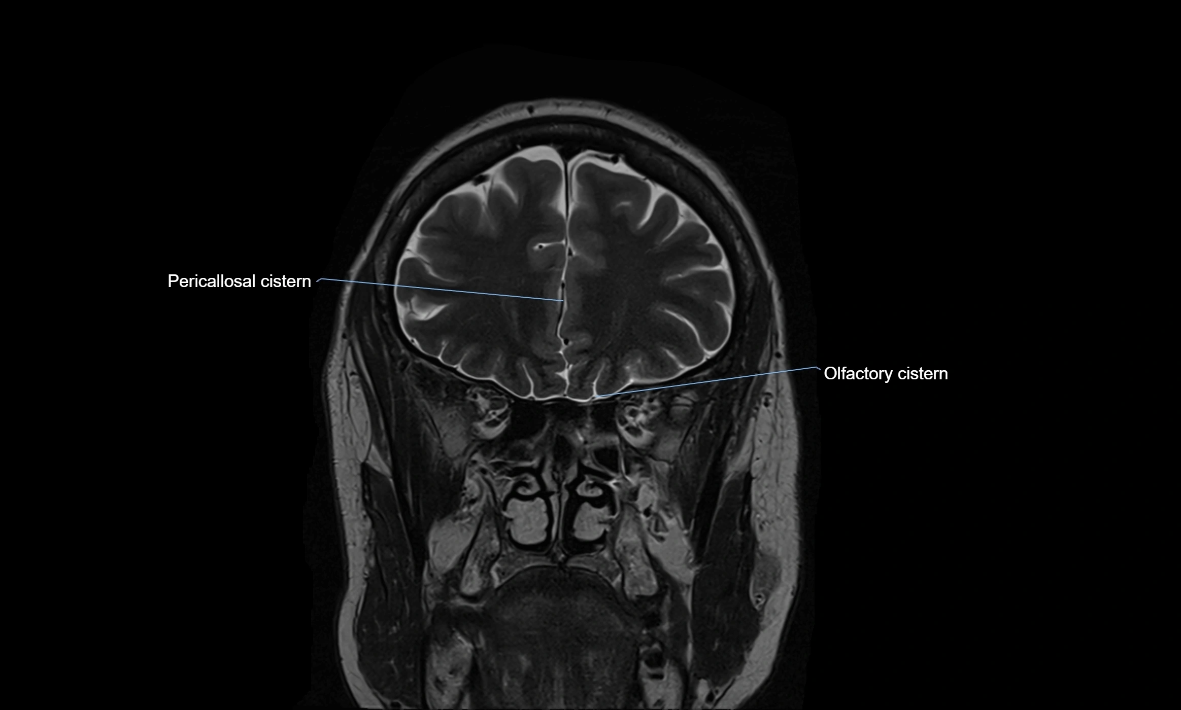 Brain cisterns  and ventricles coronal anatomy 3T MRI image-img-00001-00012.webp